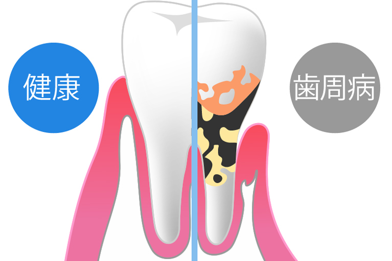 歯周病